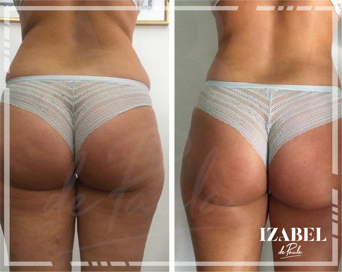 Levantamiento de glúteos® | Gel de masaje profesional - Imagen 3